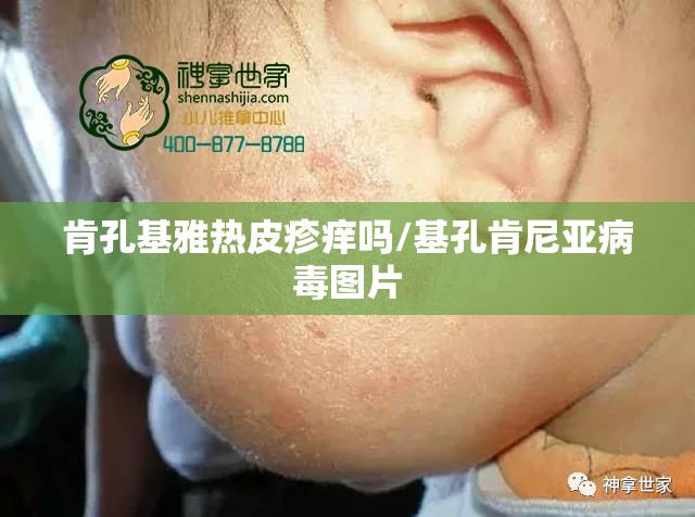 肯孔基雅热皮疹痒吗/基孔肯尼亚病毒图片