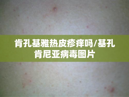肯孔基雅热皮疹痒吗/基孔肯尼亚病毒图片