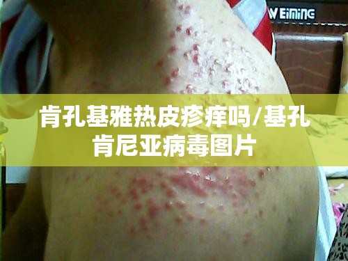 肯孔基雅热皮疹痒吗/基孔肯尼亚病毒图片
