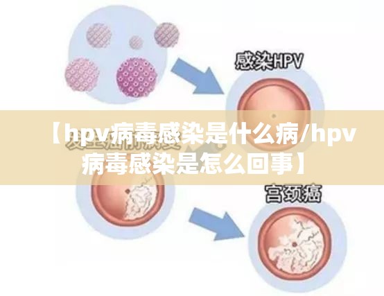 【hpv病毒感染是什么病/hpv病毒感染是怎么回事】