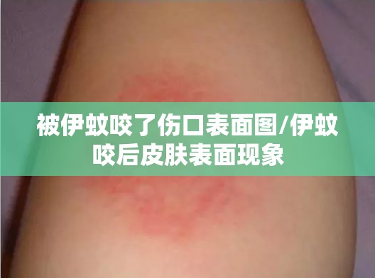 被伊蚊咬了伤口表面图/伊蚊咬后皮肤表面现象
