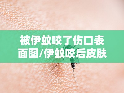 被伊蚊咬了伤口表面图/伊蚊咬后皮肤表面现象