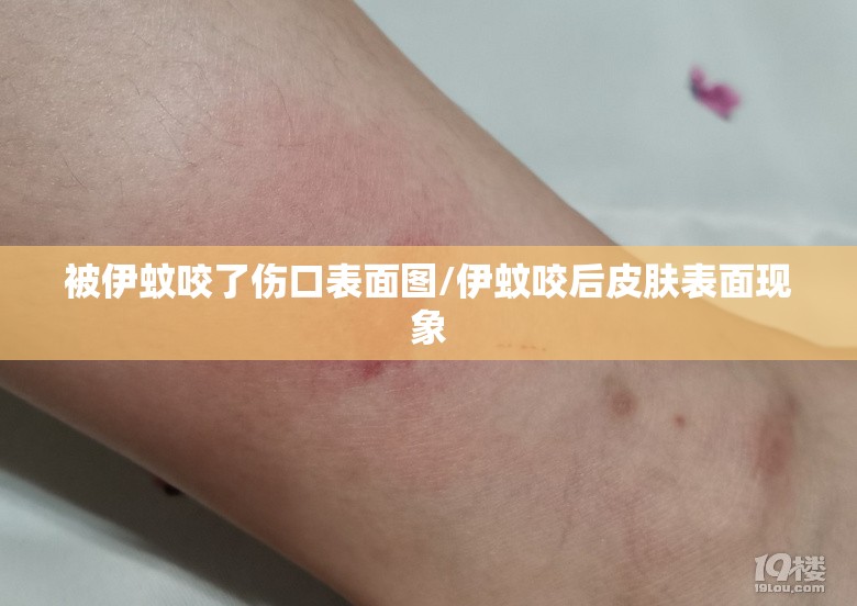 被伊蚊咬了伤口表面图/伊蚊咬后皮肤表面现象