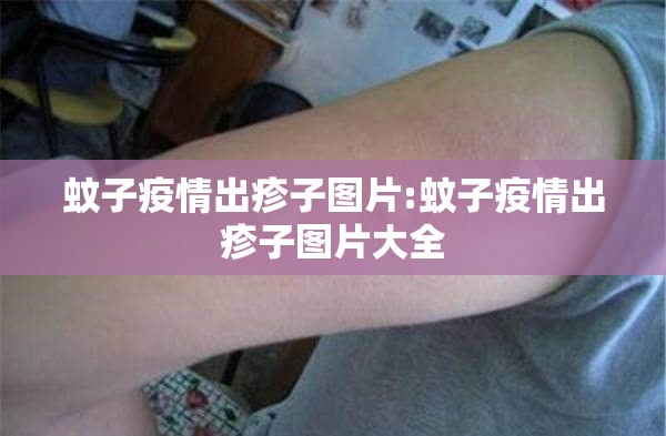 蚊子疫情出疹子图片:蚊子疫情出疹子图片大全