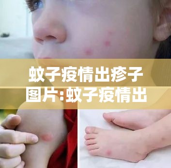 蚊子疫情出疹子图片:蚊子疫情出疹子图片大全