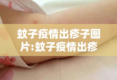 蚊子疫情出疹子图片:蚊子疫情出疹子图片大全