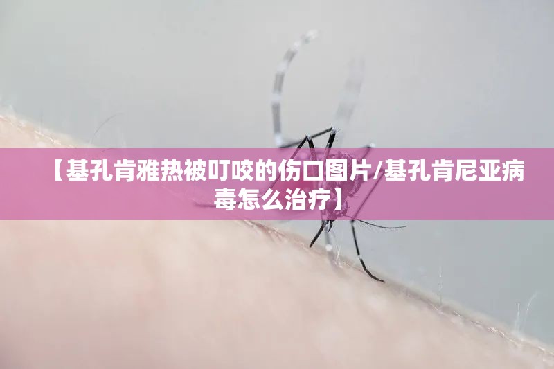 【基孔肯雅热被叮咬的伤口图片/基孔肯尼亚病毒怎么治疗】