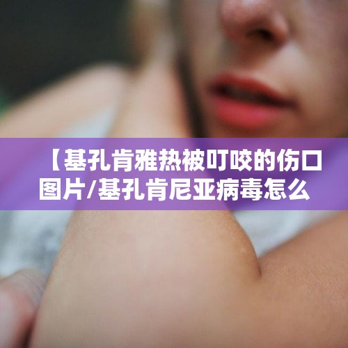 【基孔肯雅热被叮咬的伤口图片/基孔肯尼亚病毒怎么治疗】