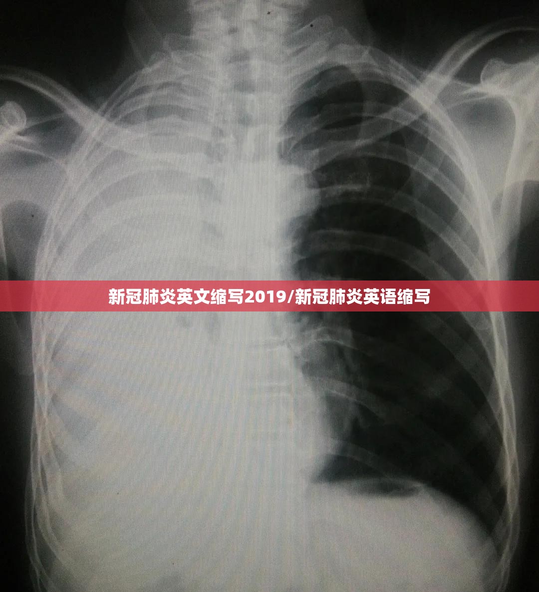 新冠肺炎英文缩写2019/新冠肺炎英语缩写