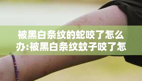 被黑白条纹的蛇咬了怎么办:被黑白条纹蚊子咬了怎么止痒