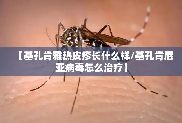 【基孔肯雅热皮疹长什么样/基孔肯尼亚病毒怎么治疗】