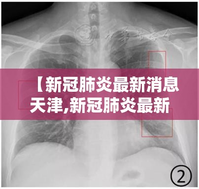 【新冠肺炎最新消息天津,新冠肺炎最新消息天津】