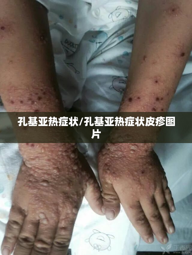 孔基亚热症状/孔基亚热症状皮疹图片
