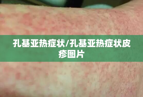孔基亚热症状/孔基亚热症状皮疹图片