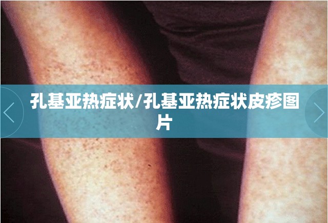 孔基亚热症状/孔基亚热症状皮疹图片