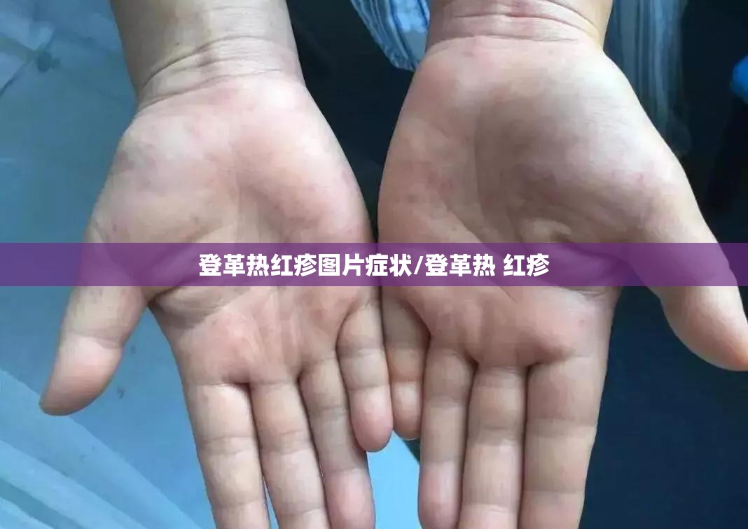 登革热红疹图片症状/登革热 红疹