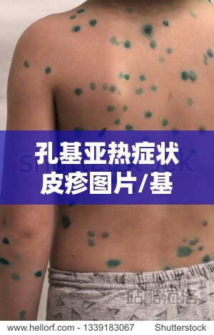 孔基亚热症状皮疹图片/基孔亚病毒
