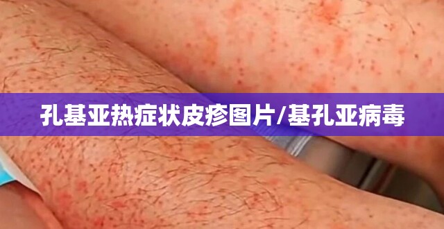 孔基亚热症状皮疹图片/基孔亚病毒