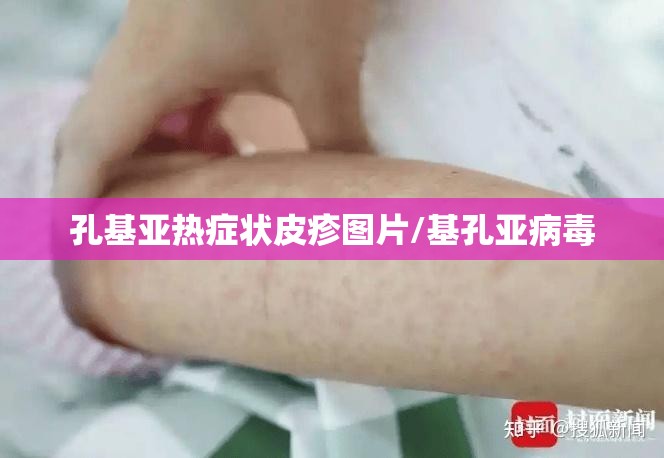 孔基亚热症状皮疹图片/基孔亚病毒