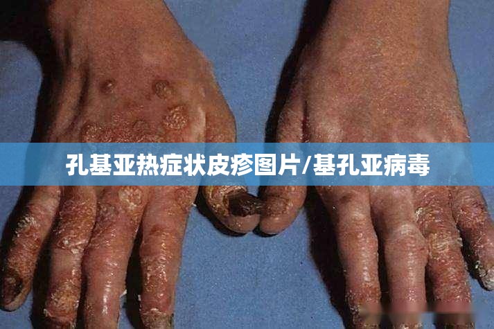 孔基亚热症状皮疹图片/基孔亚病毒