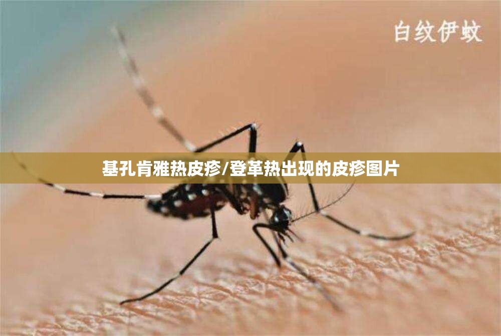 基孔肯雅热皮疹/登革热出现的皮疹图片