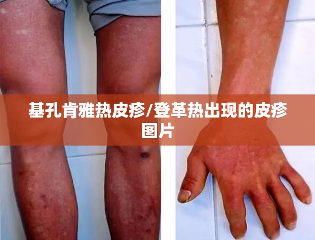 基孔肯雅热皮疹/登革热出现的皮疹图片