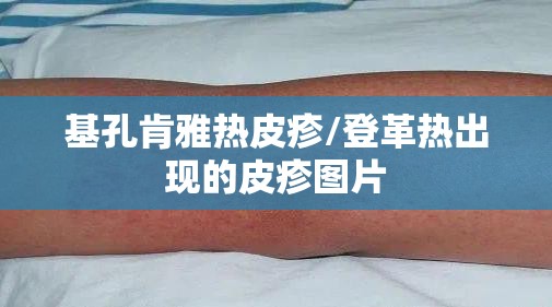 基孔肯雅热皮疹/登革热出现的皮疹图片