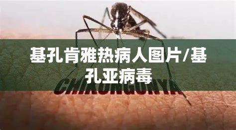 基孔肯雅热病人图片/基孔亚病毒