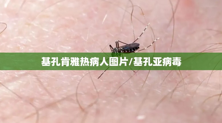 基孔肯雅热病人图片/基孔亚病毒