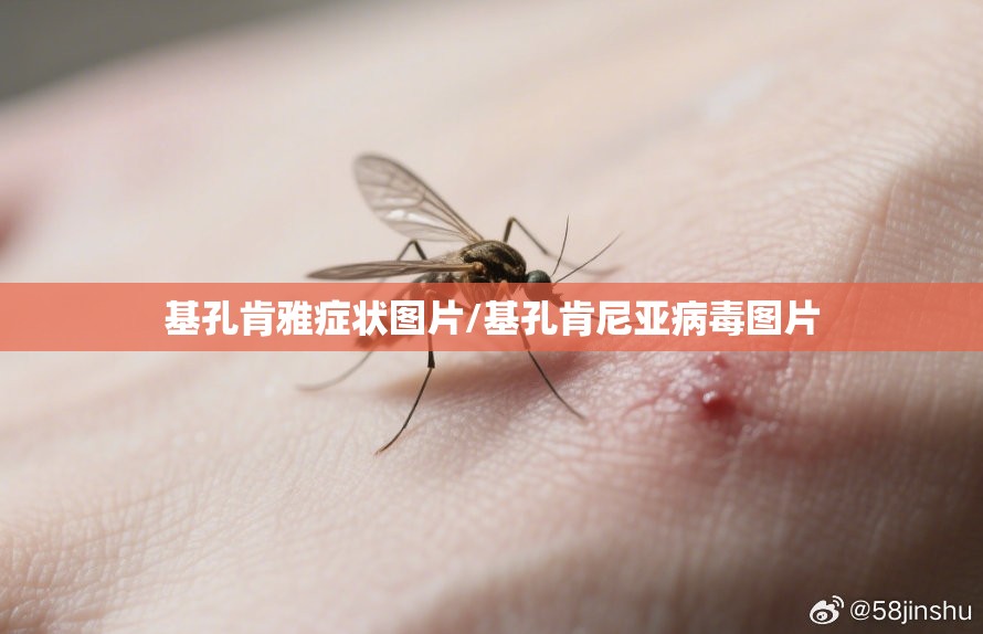 基孔肯雅症状图片/基孔肯尼亚病毒图片