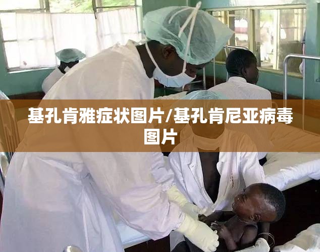 基孔肯雅症状图片/基孔肯尼亚病毒图片