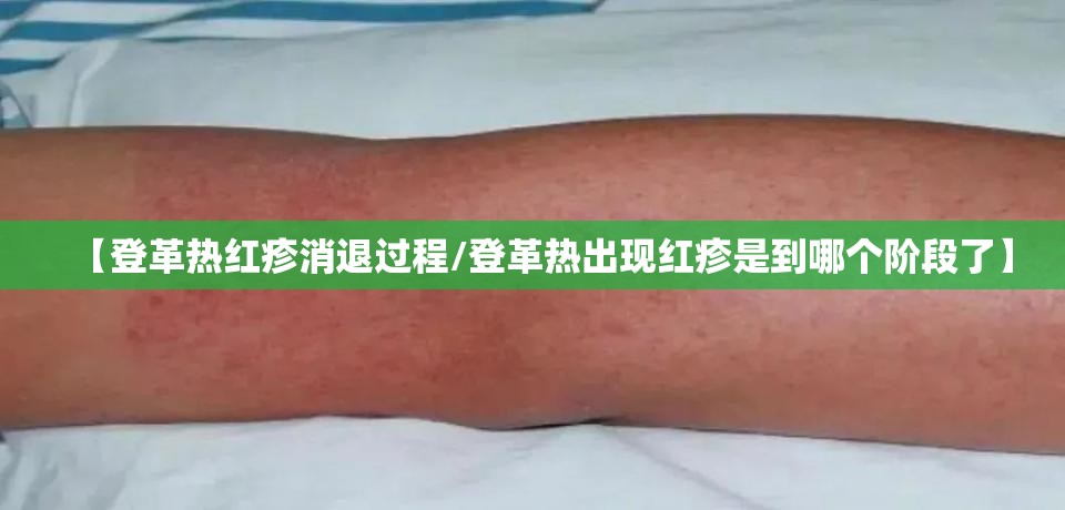 【登革热红疹消退过程/登革热出现红疹是到哪个阶段了】