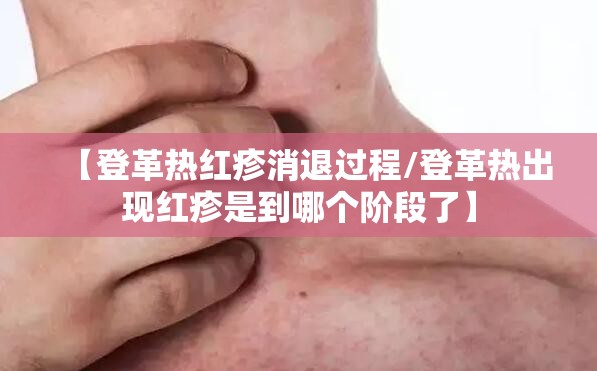 【登革热红疹消退过程/登革热出现红疹是到哪个阶段了】