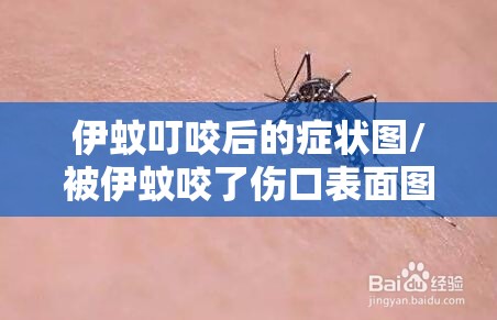 伊蚊叮咬后的症状图/被伊蚊咬了伤口表面图