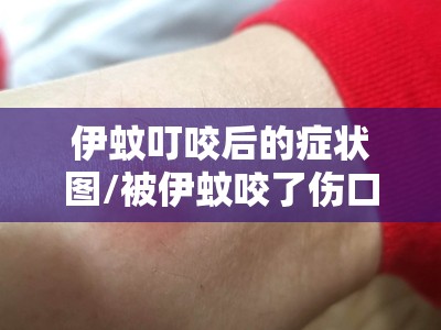伊蚊叮咬后的症状图/被伊蚊咬了伤口表面图