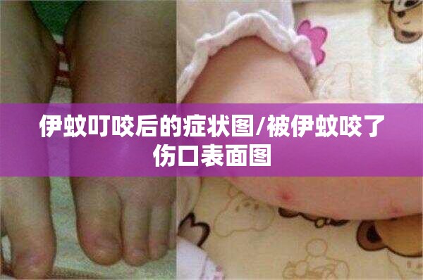 伊蚊叮咬后的症状图/被伊蚊咬了伤口表面图