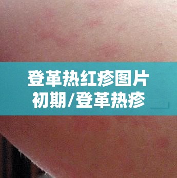 登革热红疹图片初期/登革热疹子图片