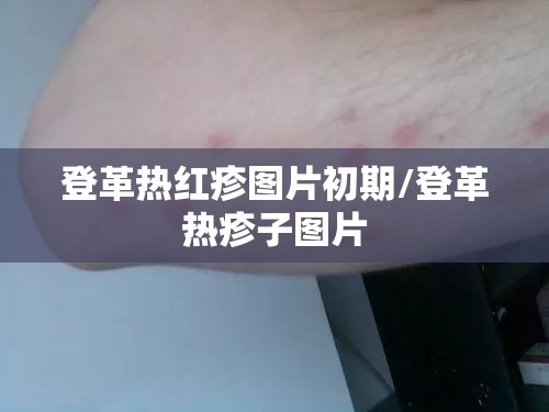 登革热红疹图片初期/登革热疹子图片