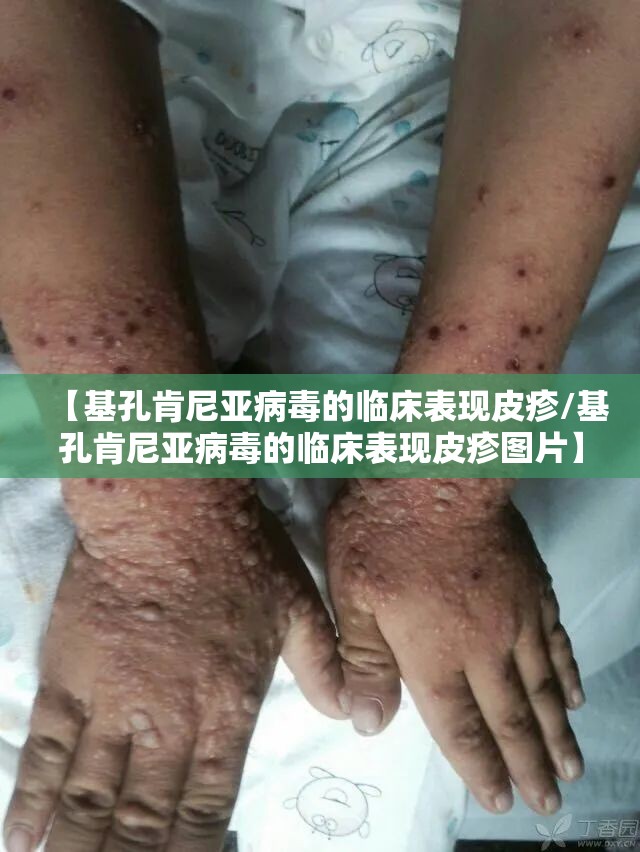 【基孔肯尼亚病毒的临床表现皮疹/基孔肯尼亚病毒的临床表现皮疹图片】