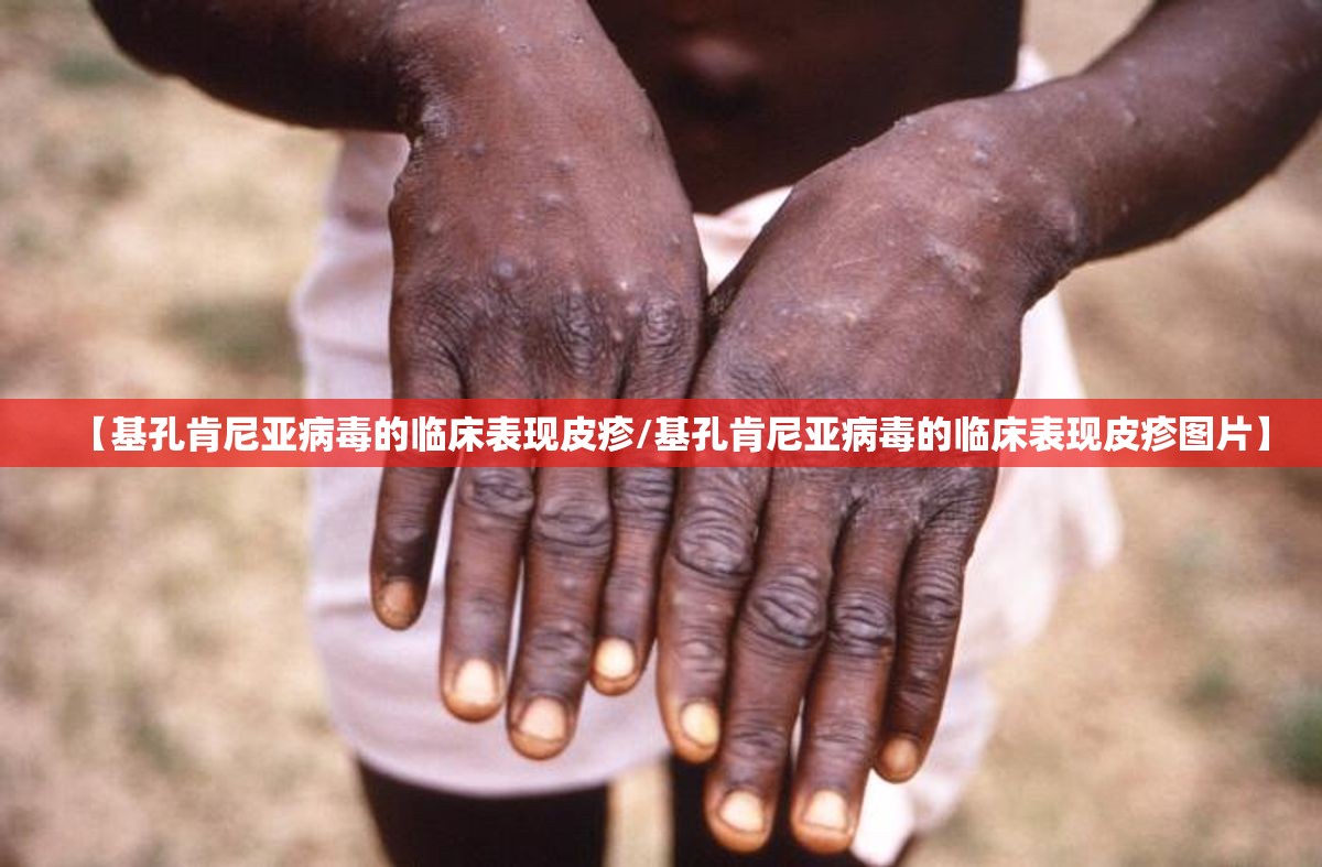 【基孔肯尼亚病毒的临床表现皮疹/基孔肯尼亚病毒的临床表现皮疹图片】