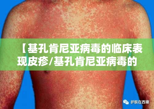 【基孔肯尼亚病毒的临床表现皮疹/基孔肯尼亚病毒的临床表现皮疹图片】
