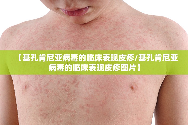 【基孔肯尼亚病毒的临床表现皮疹/基孔肯尼亚病毒的临床表现皮疹图片】