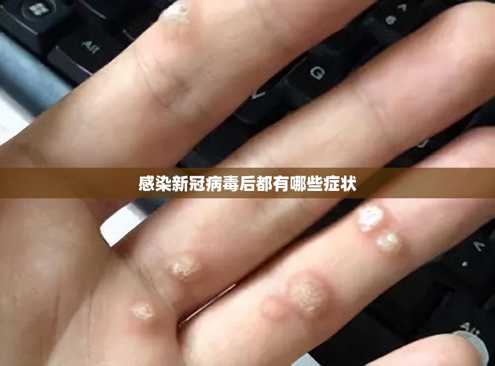 感染新冠病毒后都有哪些症状