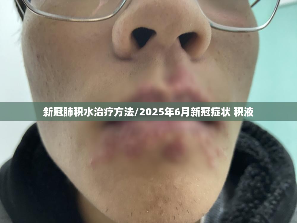 新冠肺积水治疗方法/2025年6月新冠症状 积液