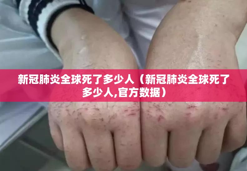 新冠肺炎全球死了多少人（新冠肺炎全球死了多少人,官方数据）