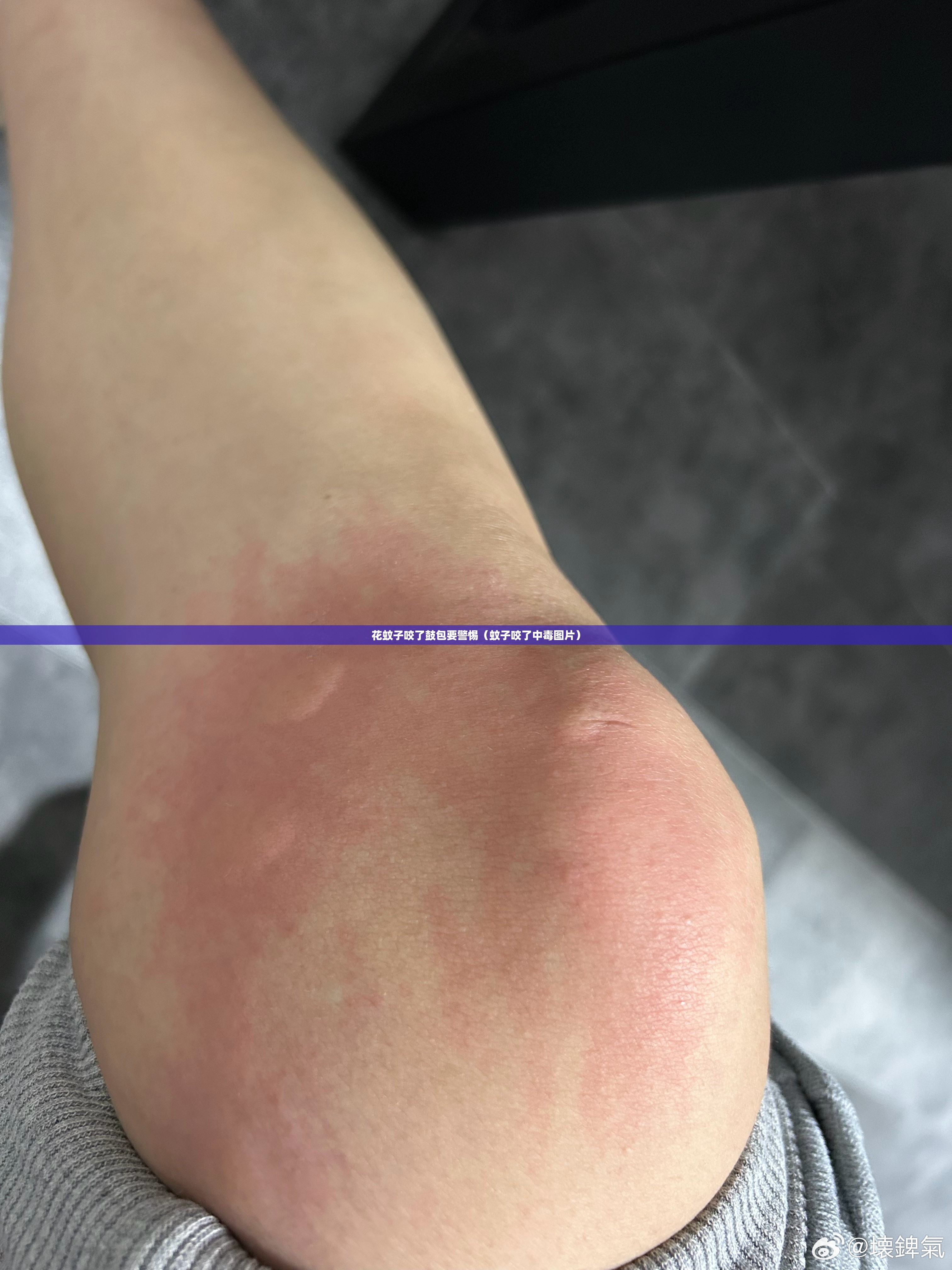 花蚊子咬了鼓包要警惕（蚊子咬了中毒图片）