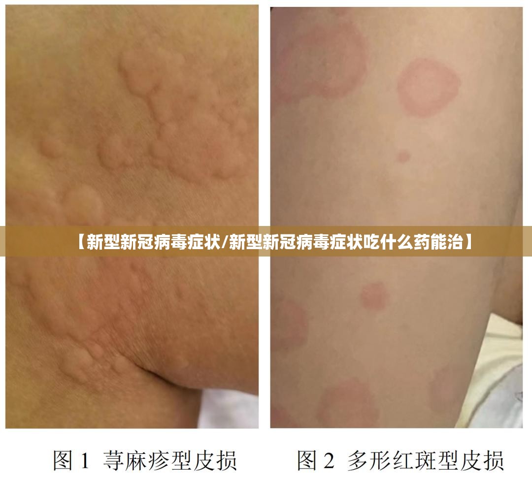 【新型新冠病毒症状/新型新冠病毒症状吃什么药能治】