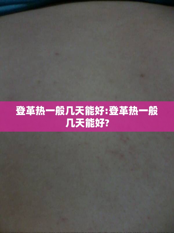 登革热一般几天能好:登革热一般几天能好?