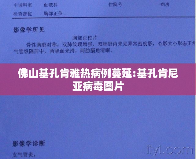 佛山基孔肯雅热病例蔓延:基孔肯尼亚病毒图片