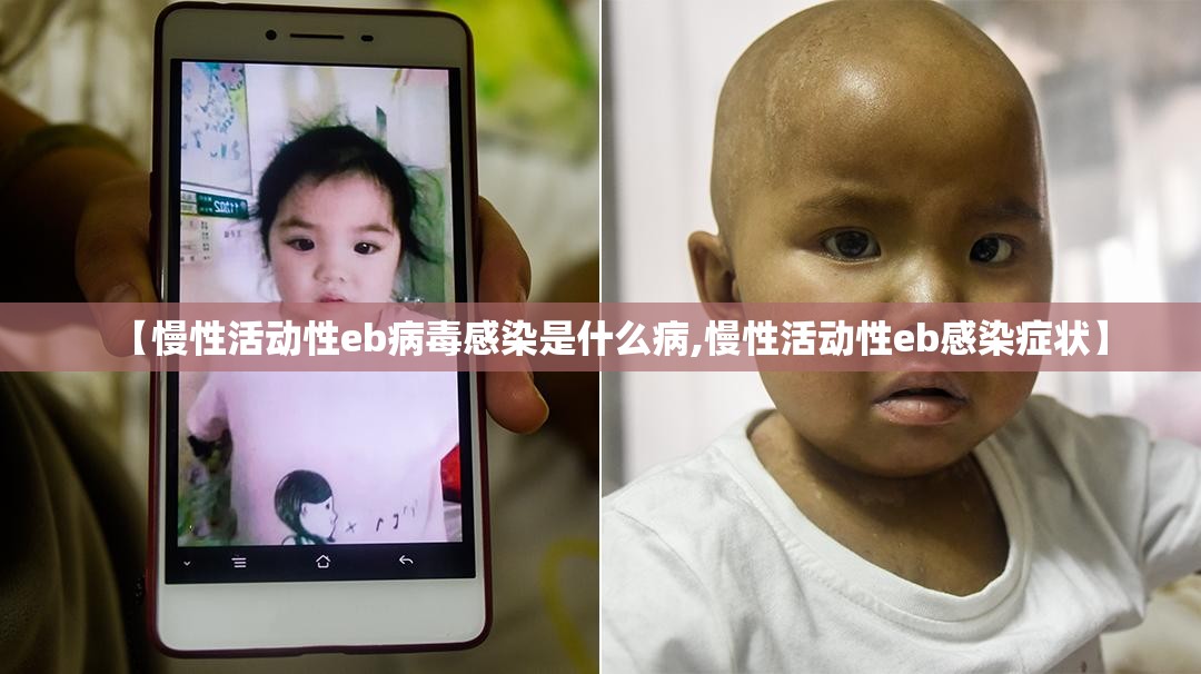 【慢性活动性eb病毒感染是什么病,慢性活动性eb感染症状】